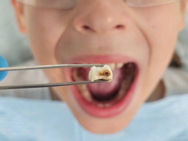 Best Chipped Tooth Repair Near Me  in Hamilton, MT